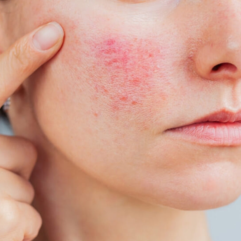 Rosacea