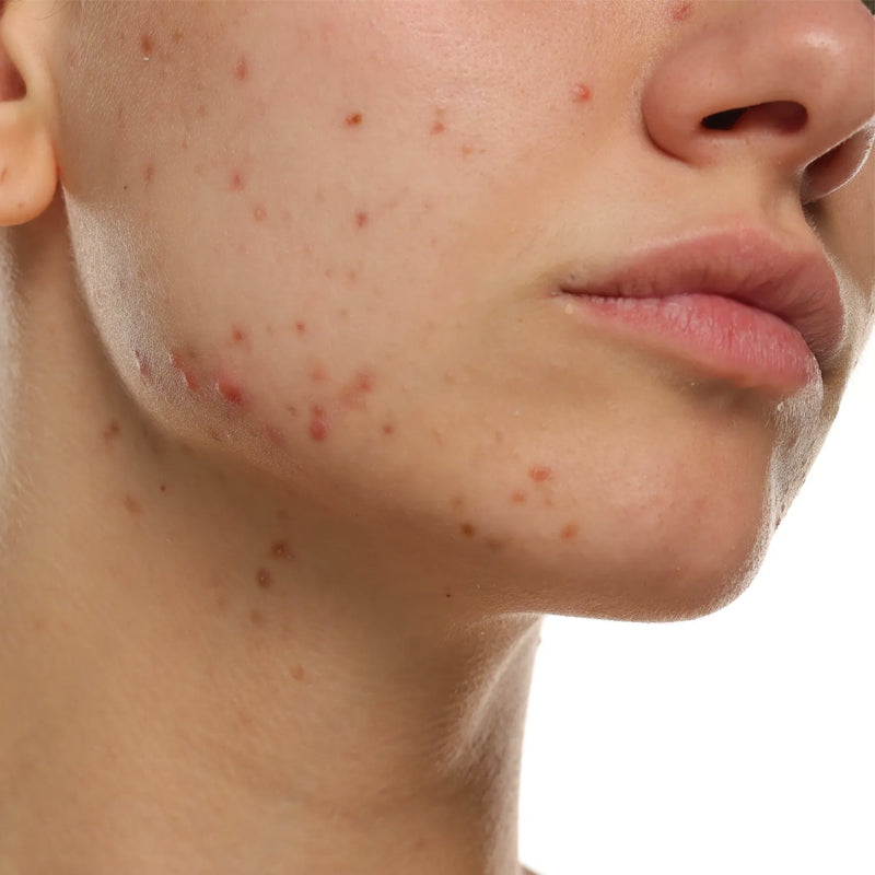 Acne / Vette huid